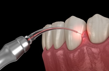 Illustrated dental laser treating gum disease