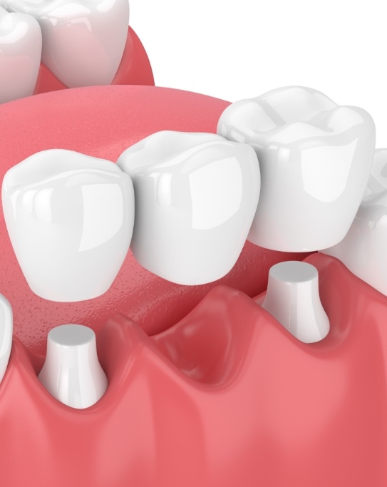 Illustrated dental bridge replacing a missing tooth