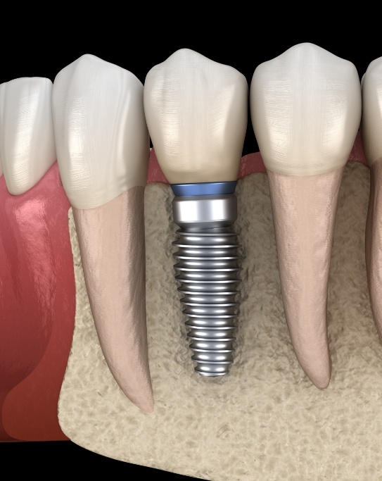 Illustrated dental implant replacing a missing tooth