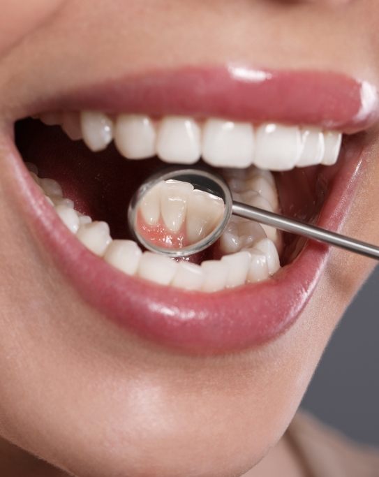 Close up of dental mirror inside of mouth