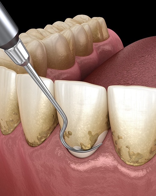 Scaling and root planing is a treatment that removes excess plaque from above and below the gumline