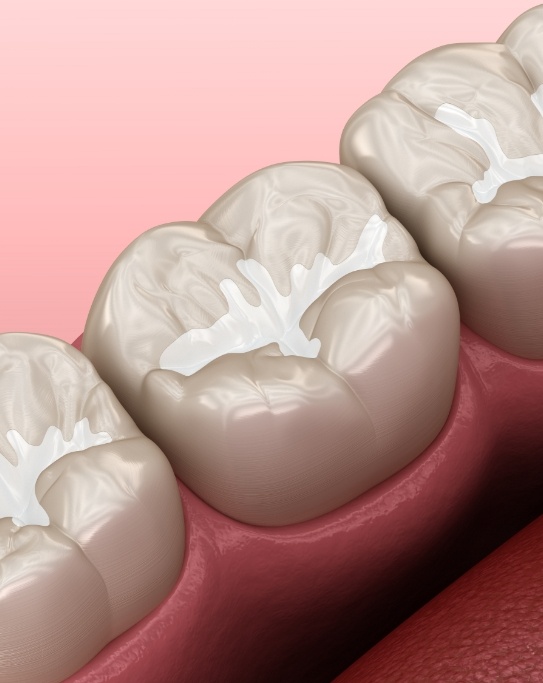 Illustrated row of teeth with white fillings