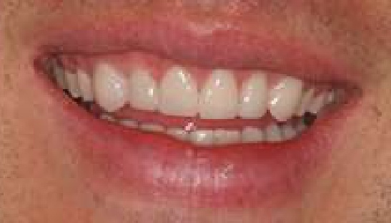 Close up of improved smile after dental treatment