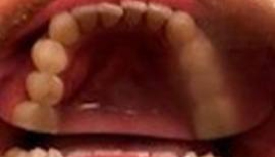 Arch of misaligned teeth