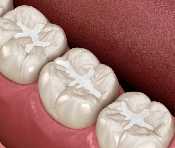 Illustrated row of teeth with tooth colored fillings in New York