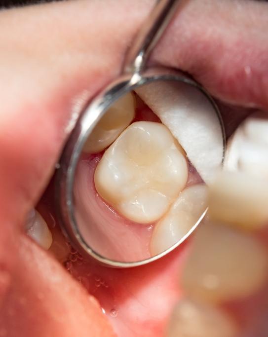 Close up of dental mirror in mouth reflecting a white tooth