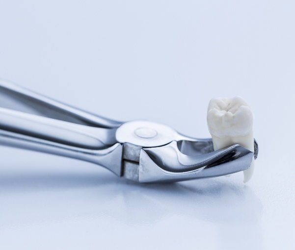 Dental clasp holding an extracted tooth