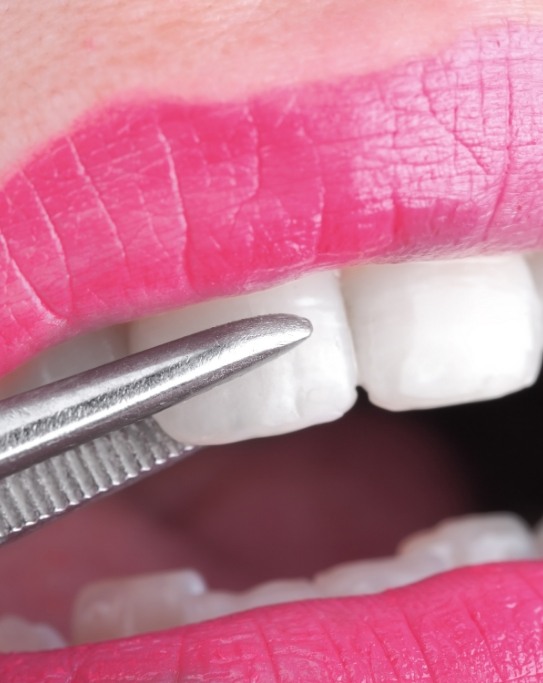 Close up of veneer being placed over a tooth