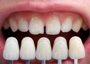 Imperfect teeth compared to porcelain veneers.