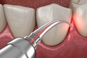 Soft tissue laser for crown lengthening