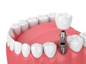 dental implants 3D illustration 