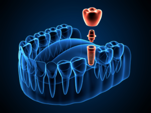 a 3D render of the dental implant process