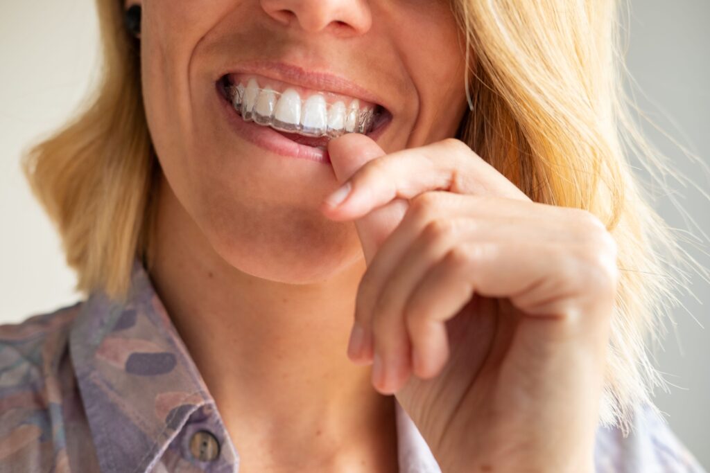 Nose-to-neck view of someone pushing Invisalign over upper arch
