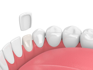Illustration of veneer coming off a tooth